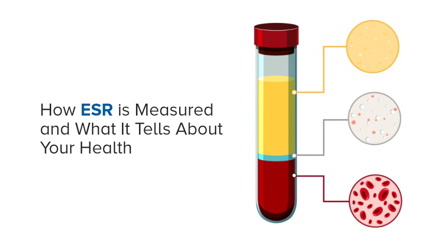 How ESR is Measured and What It Tells About Your Health